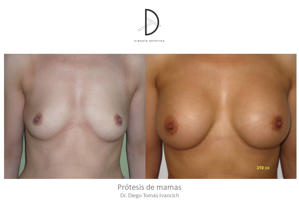 Aumento de pecho lactancia Protesis de mamas 310cc Dr Diego Tomas Ivancich Clinica DT de cirugia estetica Madrid